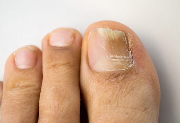 Typische mikrobiologische Schädigung: Fußnagel, der an Nagelpilz leidet.