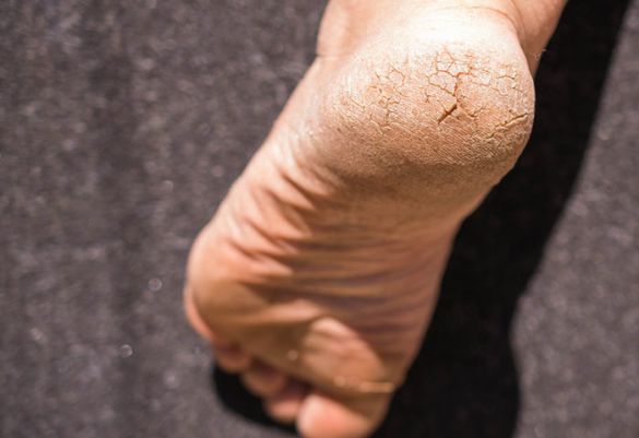 Schmerzhafte Angelegenheit: Hautrisse an den Füßen