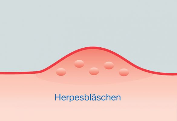 Herpesbläschen in der Nahansicht (schematischen Darstellung)