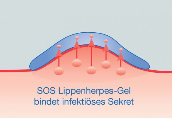Die Kieselsäure, wie sie im SOS Lippenherpes-Gel enthalten ist, bindet das Wundsekret der Herpes-Bläschen.